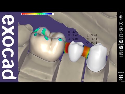 exocad Video Tutorial: Designing a Three-Element Bridge